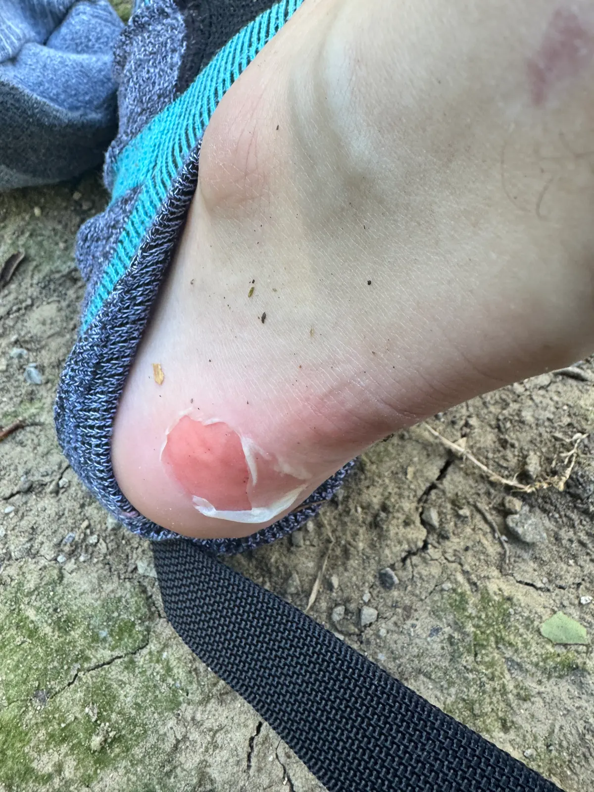 A torn blister on the back of a heel, sock pulled down, beside a ruck strap on the ground